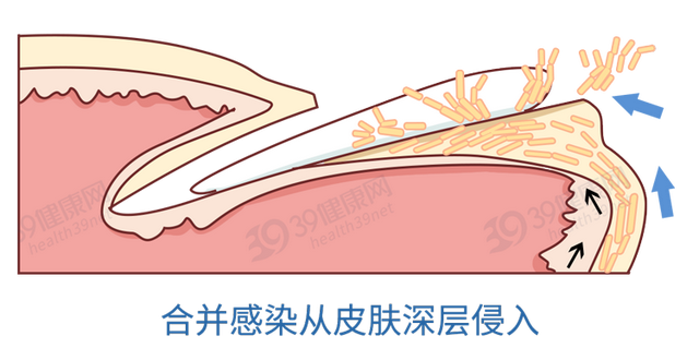得了灰指甲，反复发作难根治？一次性介绍7种药，总有一款适合你