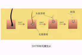 脱发为何一般从前额或者头顶开始？图片