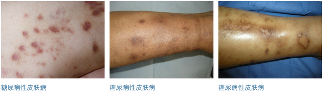 角化过度角化不全炎症