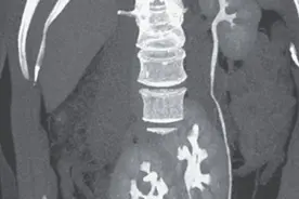 巴西男子腰疼就医，拍片照出仨肾都能正常工作，网友：厉害了老铁图片