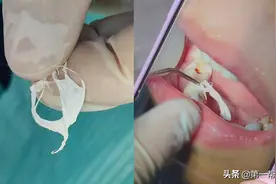 六岁女童牙齿发炎，一查家长怒了：竟被门诊填充了化工塑料图片