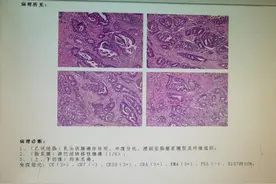 出现便血，是肠癌还是痔疮？医生教你从三方面辨别，别再混淆了图片