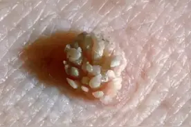 私处长肉疙瘩，一定是得性病了？图片