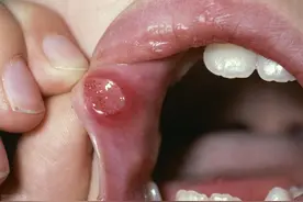 有一种痛，叫口腔溃疡，补充维C不顶用，这些办法才靠谱图片