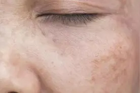 黄褐斑治不好？复发更难搞？这些治疗黄褐斑的方法你一定要看图片