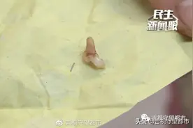 难怪越治越疼，原来牙里藏着一根针图片