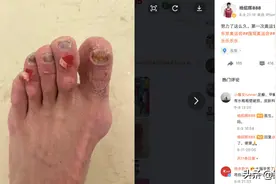 杨绍辉东奥马拉松赛后满脚水泡，比起跑步膝水泡才更可怕图片