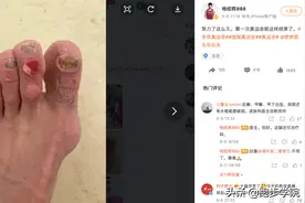杨绍辉东奥马拉松赛后满脚水泡，比起跑步膝水泡才更可怕图片