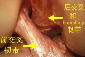 前交叉韧带手术是怎么做的？术后效果怎么样？图片