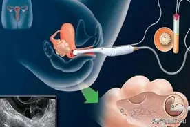 健康科普堂 | 肚子疼流血都查它，阴式超声到底有多神？图片