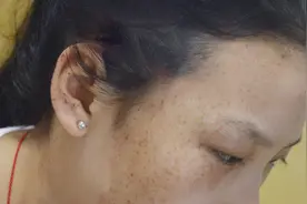 脸上长雀斑，是否孩子也会有呢？这些知识要了解！