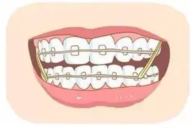 戴牙套要怎样保持口腔清洁？教你这三个方法图片