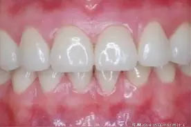 健康和不健康的牙龈都长什么样？图片