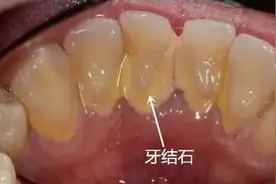 牙龈出血就算了，还伴有口臭？该怎么办才好？图片