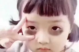 黑眼圈：十六七岁一直伴有黑眼圈，如何能改善黑眼圈？图片