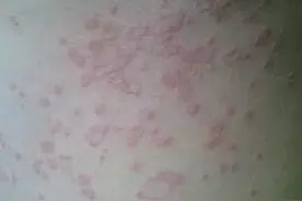 什么是玫瑰糠疹，玫瑰糠疹要如何治疗？图片