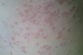 什么是玫瑰糠疹，玫瑰糠疹要如何治疗？图片