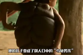 男孩天生长着“乌龟壳”，被村民当成怪物，爱心医生帮他重新做人图片