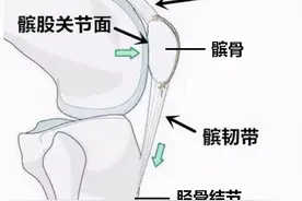 什么是髌骨软化症？是缺钙引起的吗？图片