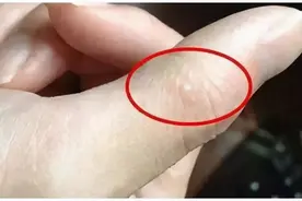一挤就痒痒痒！夏天手上长出的白色“小水泡”，这里告诉你怎么治图片