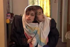 双胞胎连体30年，生命垂危有谁能拯救他们呢图片