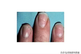 赶紧看看你的指甲，出现这种状况可能是生病了图片