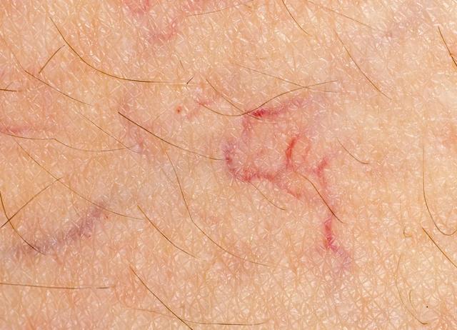 皮肤上出现很多小红点 皮肤上出现很多小红点