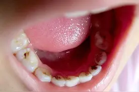 号称“蛀牙救星”的根管治疗，凭什么比补牙贵好几倍？图片