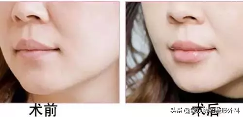 常见的唇部整形都有哪些？