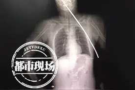 触目惊心！江西一男子被钢筋刺穿身体插进颅内，奇迹生还图片