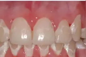 牙齿脱矿是什么？该怎么处理？图片