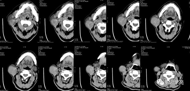 腮腺角化型鳞癌