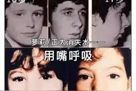 张口呼吸会长歪，用“闭嘴贴”？医生：胡来！图片