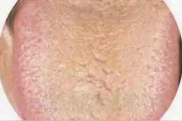 看看舌头就知道自己身体状况，5种常见问题的舌象。图片