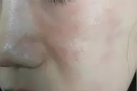 冬季皮肤干燥、瘙痒、脱屑，可能是这5种皮肤问题图片