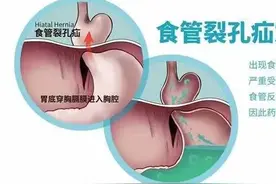 您知道食管裂孔疝吗？图片