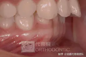 成都牙齿矫正｜齿科颜值管理之「男女有别」图片