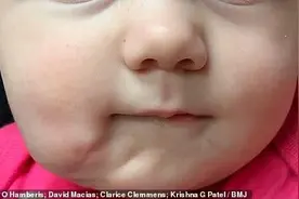 美国女婴生来就有第二张完整的嘴，有嘴唇、牙齿和舌头图片