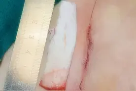 肋软骨虽热门，但并非初鼻整形的唯一选择图片