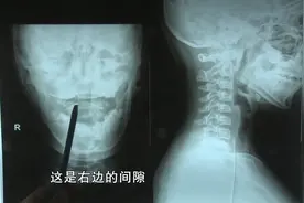 长期躺卧玩手机，12岁男孩竟致颈椎半脱位！医生：少低头看手机