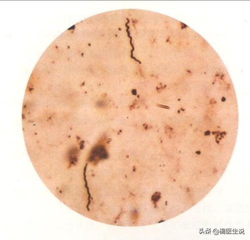 梅毒到底能不能治愈？看医生怎么说！