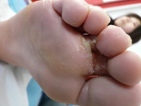 汗脚,脚臭,脚气,你到底得的是哪一种?