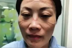 “勒痕脸”国际版：记住这些医护人员的脸庞，他们是最可爱的人图片