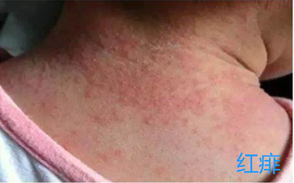 小孩胳膊膝盖鸡皮肤图片大全