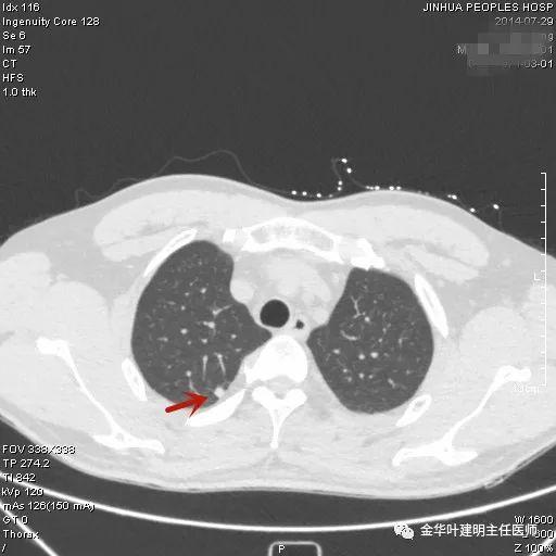 叶建明谈结节：检查发现肺实性结节怎么办？个人版实用指南