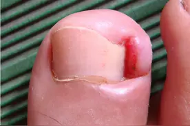 脚趾甲总往肉里“钻”，一碰还疼？学会小妙招，或能告别甲沟炎图片