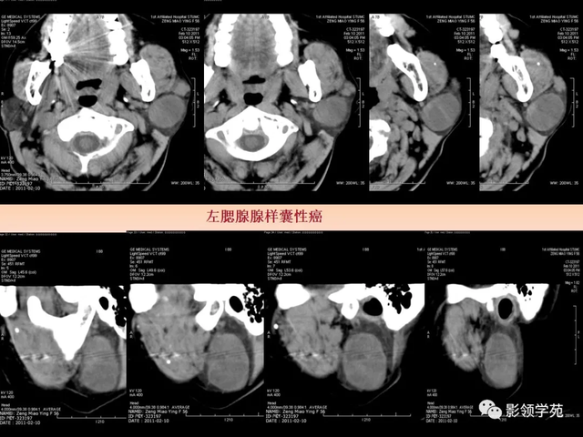 腮腺角化型鳞癌