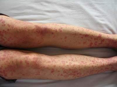 指端角化性类弹性纤维病