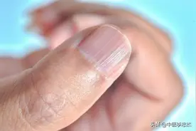 指甲上出现横竖纹是不是大病前兆？哪些情况需要立刻就医？图片