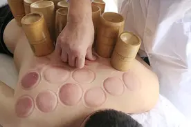 中医拔罐有啥好处？哪些人适合？哪些人不适合？图片
